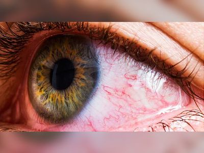 What Your Eye Symptoms May Mean