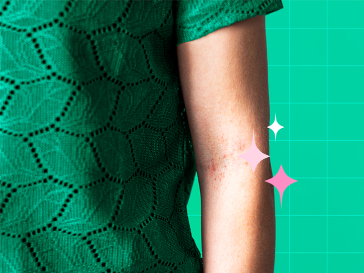 What’s the Diff Between Eczema and Psoriasis?