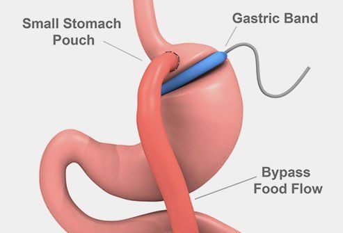 Are Gastric Bypasses Reversible?