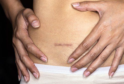 Are Adhesions and Scar Tissue the Same?