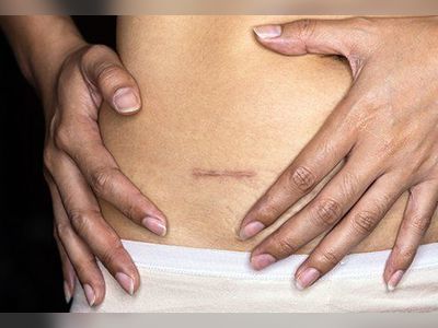 Are Adhesions and Scar Tissue the Same?