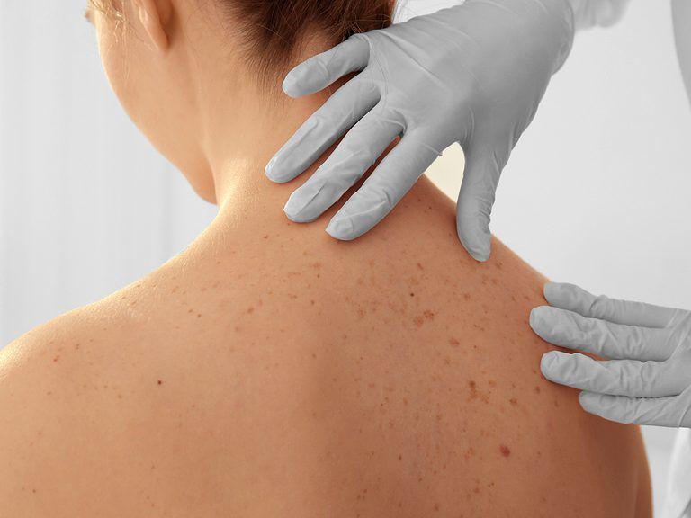 8 Surprising Facts About Skin Cancer