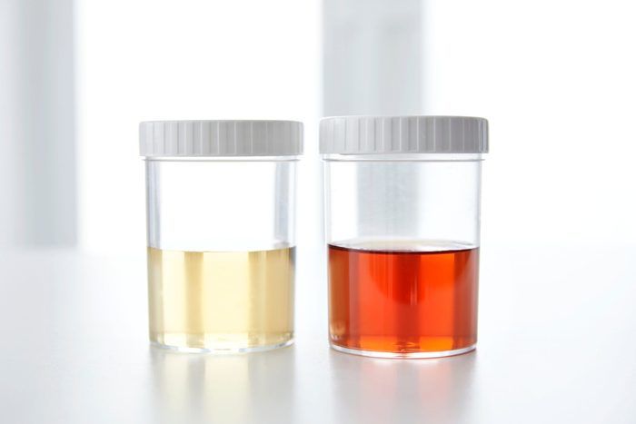 This Urine Colour Chart Reveals Exactly What Your Pee Colour Means
