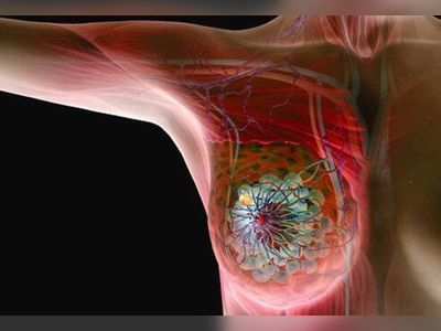 Breast Cancer Awareness: Symptoms, Diagnosis, and Treatment
