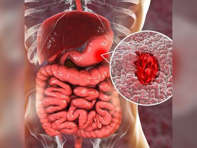 Digestive Disorders: Visual Guide to Stomach Ulcers