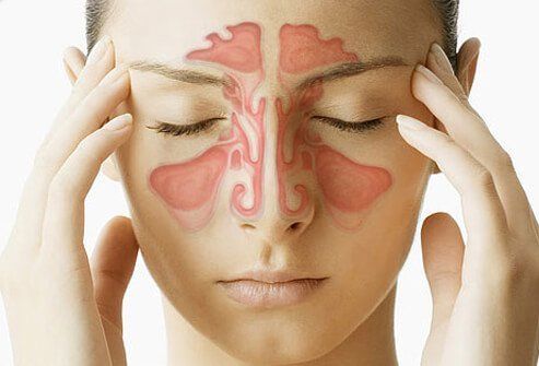 Sinus Infection (Sinusitis) Symptoms & Treatment