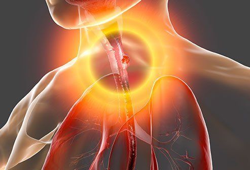 Esophageal Cancer (Cancer of the Esophagus)