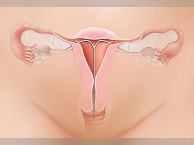 IUD (Intrauterine Device) Types, Effectiveness, and Side Effects