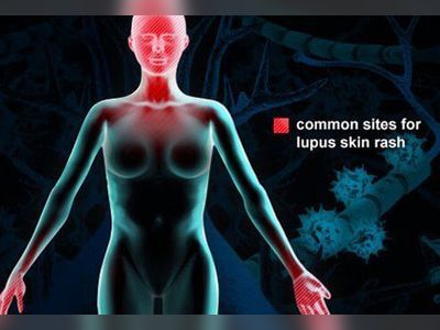 What Is Lupus? Symptoms, Rash, and Treatment