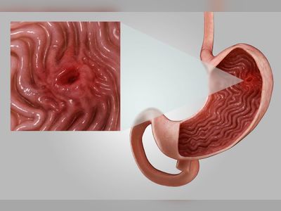What Is a Stomach Ulcer? Here's What You Need to Know About Symptoms and Treatment